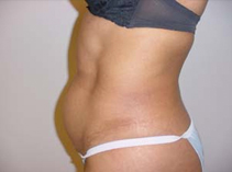 An image displaying the contrast between a woman's abdominal area prior to and following a tummy tuck surgery.