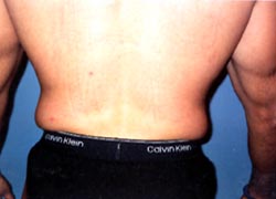 Love Handles Liposuction For Men