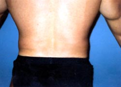 Love Handles Liposuction For Men