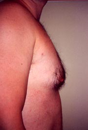 Chest Liposuction For Men