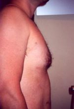 Chest Liposuction For Men