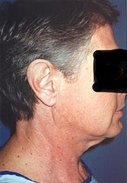 Liposuction of Neck Result Santa Monica and Los Angeles