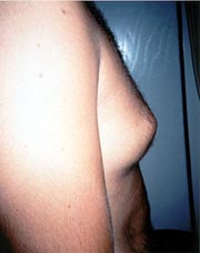 Male Liposuction Santa Monica and Los Angeles