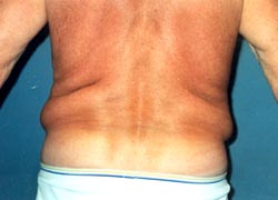 Lipo of Love Handles Result Santa Monica and Los Angeles