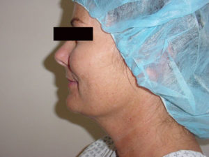 Neck Liposuction