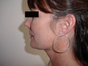 Neck Liposuction