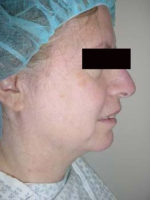 Neck Liposuction