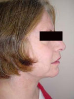 Neck Liposuction