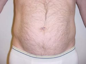 Love Handles Liposuction For Men
