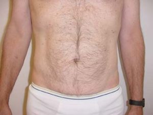 Love Handles Liposuction For Men