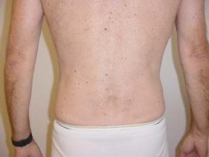 Love Handles Liposuction For Men