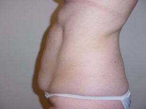 Waist Liposuction