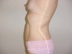 Bra Roll Liposuction in Santa Monica