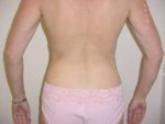 Waist Liposuction