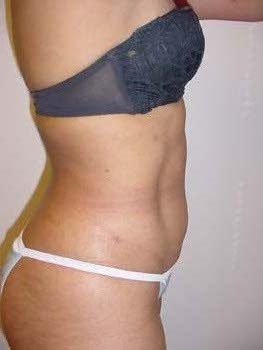 Waist Liposuction