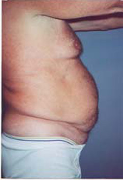 Abdomen Liposuction