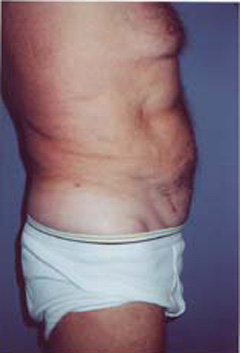 Abdomen Liposuction