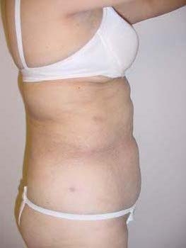 Liposuction of Abdomen