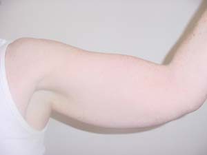 Arms Liposuction