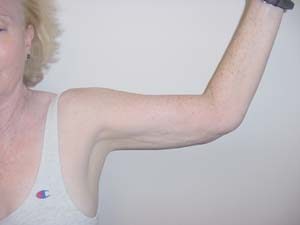 Arms Liposuction