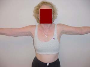Arms Liposuction