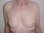 Chest Liposuction For Men