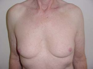 Chest Liposuction For Men