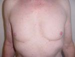 Chest Liposuction For Men