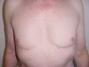 Chest Liposuction For Men