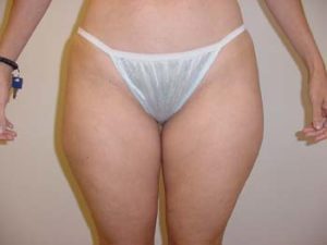 Thighs Liposuction