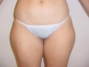 Thighs Liposuction