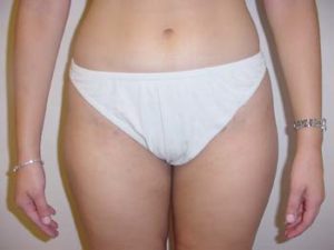 Thighs Liposuction