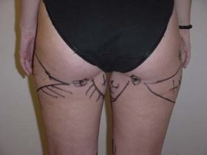 Thighs Liposuction