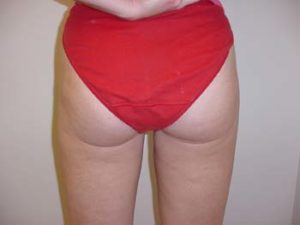 Thighs Liposuction