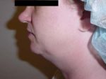 Neck Liposuction