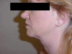 Neck Liposuction