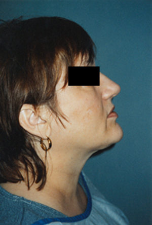 Neck Liposuction