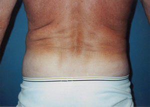 Waist Liposuction