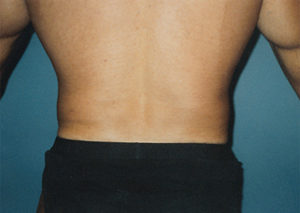 Waist Liposuction