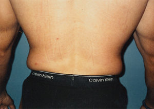 Waist Liposuction