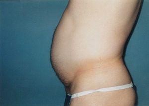 Abdomen Liposuction