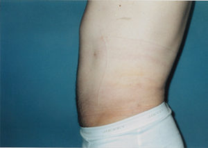 Abdomen Liposuction