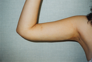 A lady showing her arm after lipo surgery
