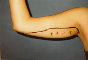 A lady showing her arm before lipo surgery