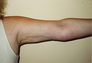 Arms Liposuction