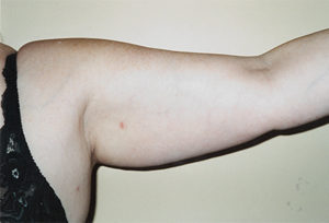 Arms Liposuction