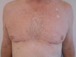 Chest Liposuction For Men