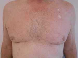 Chest Liposuction For Men