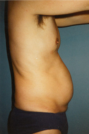 Abdomen Liposuction