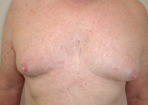 Chest Liposuction For Men